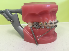 Forsus Springs | Correcting Bite Issues | Smiles and Faces Orthodontics