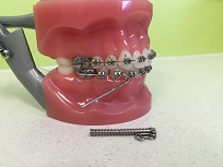 Forsus Springs | Correcting Bite Issues | Smiles and Faces Orthodontics