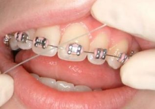 Risas Dental and Braces - Dry sockets can happen after getting any