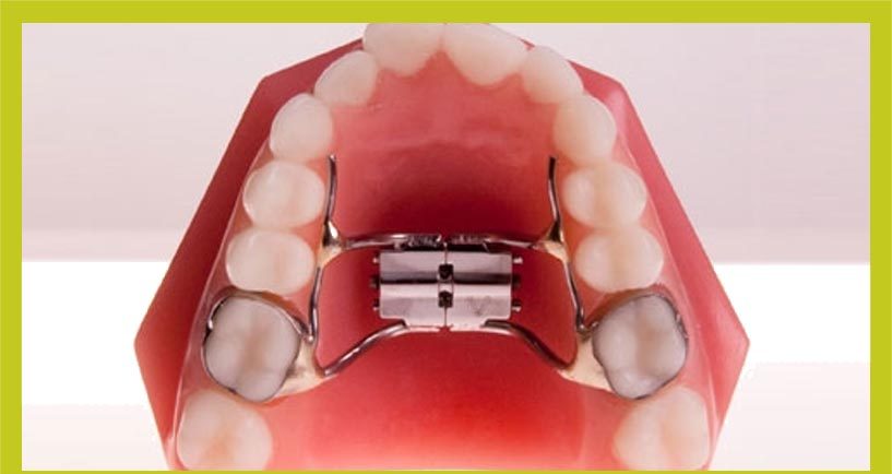 Rapid Maxillary Expander for Kids Sydney | Orthodontic Treatment